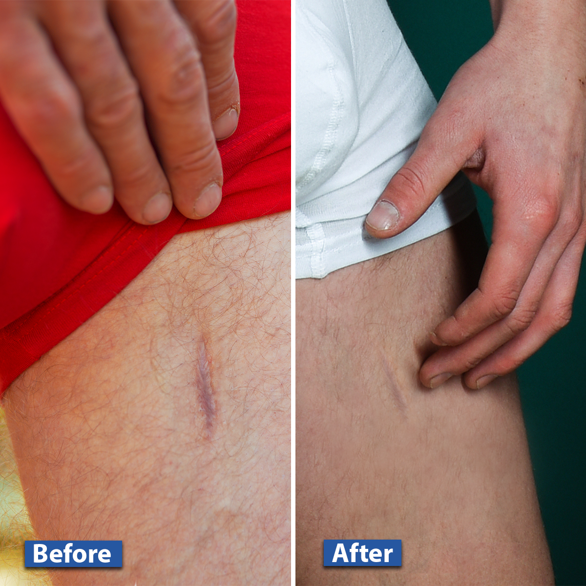 Side-by-side thigh scars: left before, right after treatment.