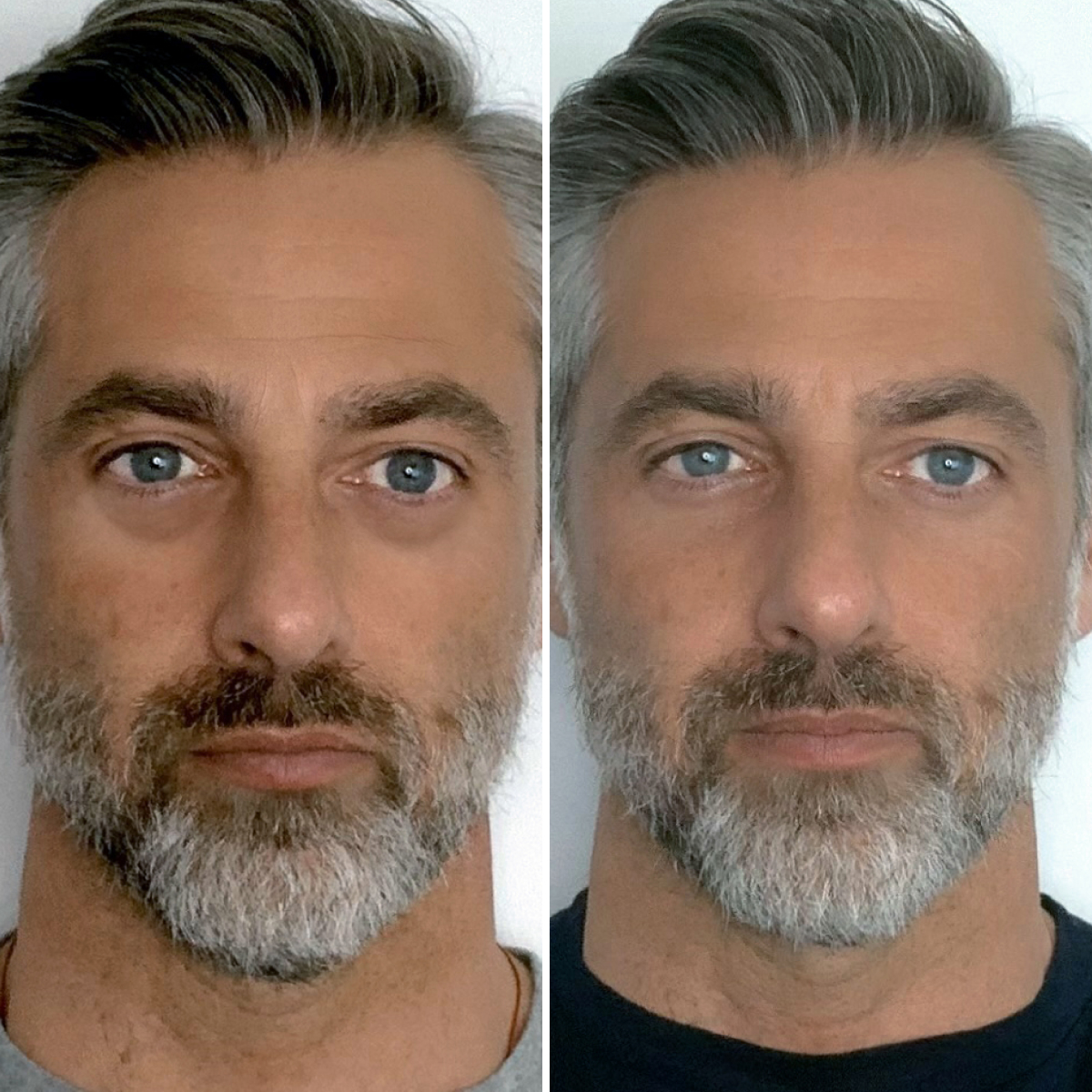 Particle Face Cream Carlos Before & After