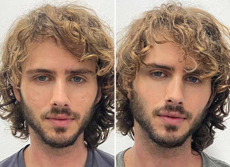 Two close-up, front-facing male portraits, before and after scar treatment