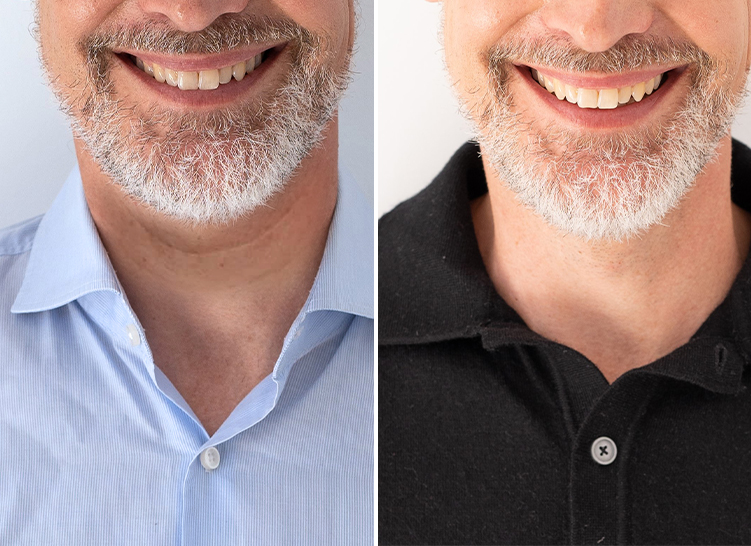 Neck skin comparison illustrating the difference before and after applying a cream.