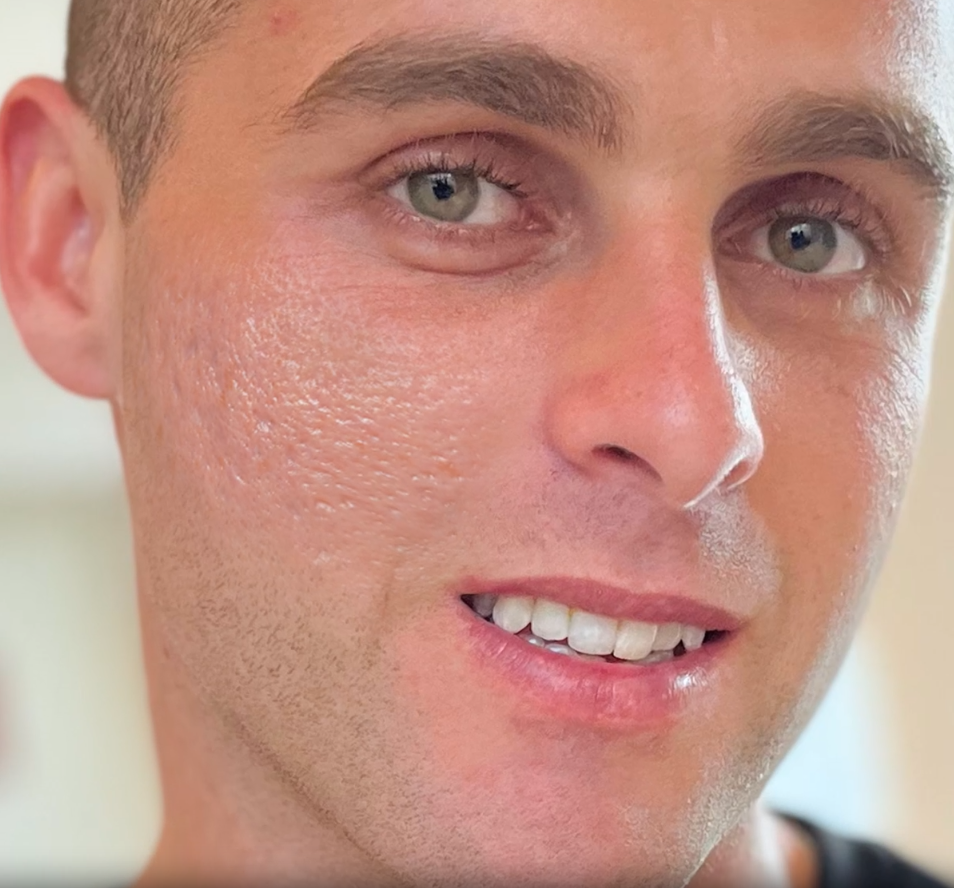 Smiling man’s face in close-up, showing skin without scars